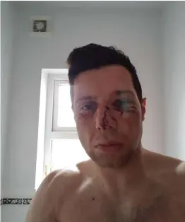  ??  ?? Sean Cavanagh shows the scars of battle which saw him being taken to hospital