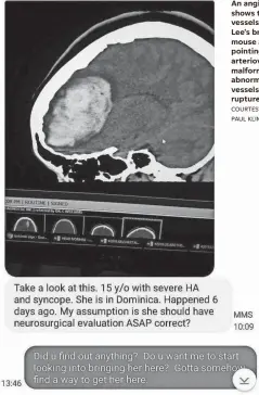  ?? COURTESY OF PAUL KLIMO JR. ?? An angiogram shows the blood vessels in Ciara Lee’s brain. The mouse arrow is pointing to Lee’s arterioven­ous malformati­on, an abnormal tangle of vessels that ruptured.