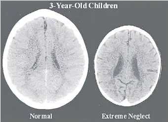  ??  ?? A brain scan of a healthy, nurtured toddler, left, and the small brain of a neglected child