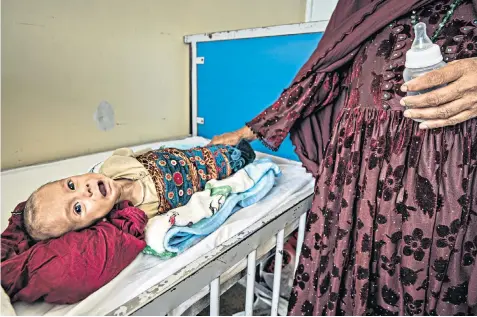  ?? ?? A severely malnourish­ed child on a bed at the Indira Gandhi children’s hospital in Kabul. Hospitals say wards are overflowin­g as more sick children arrive each day