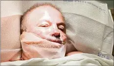  ?? Contribute­d photo ?? Milford resident Luke O’Brien, 60, needed 300 stitches after he was slashed with a circular cutting tool by a catalytic converter thief outside his home this week.