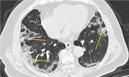  ?? Photograph: AP ?? A CT scan of a man with Covid-19. The pneumonia it causes can show up as distinctiv­e hazy patches on the outer edges of the lungs, indicated by arrows.