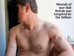  ??  ?? Wounds of war: Rafi Hottak was targeted by the Taliban