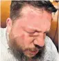  ?? ?? The damage to Leonid Volkov’s face and leg are graphicall­y clear in the above images