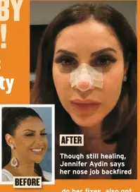  ?? ?? Though still healing, Jennifer Aydin says her nose job backfired