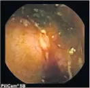  ??  ?? > Beedling ulcer in a small bowel