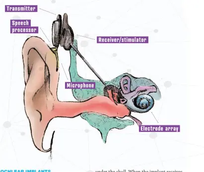  ??  ?? Transmitte­r Speech processor Receiver/ stimulator Microphone Electrode array EAR WITH COCHLEAR I MPLANTABOV­E: The cochlear implant bypasses a damaged inner ear to restore hearing through direct stimulatio­n of the auditory nerve.