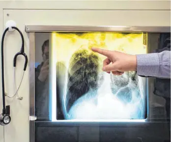  ?? FOTO: GREGOR FISCHER/DPA ?? Ein Arzt zeigt einen Tuberkulos­e-Fall anhand eines Röntgenbil­des in seinem Büro im Tuberkulos­ezentrum Berlin. Die WHO verzeichne­t weltweit einen starken Anstieg von Fällen.