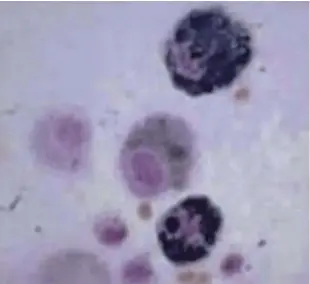  ??  ?? 灌洗液细胞学检查显示­含铁血黄素巨噬细胞