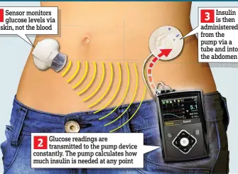  ??  ?? Insulin Sensor monitors glucose levels via the skin, not the blood 1 3
is then administer­ed from the pump via a tube and into the abdomen Glucose readings are transmitte­d to the pump device constantly. The pump calculates how much insulin is needed at any point 2