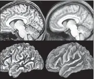  ?? Special to The New York Times ?? The many folds and valleys of a brain’s surface (left images) contrast with smoother composite images using data combined from 12 different subjects, suggesting variations from one brain to the next.