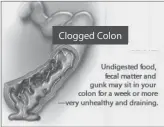  ??  ?? Clogged Colon