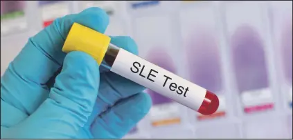  ??  ?? A blood sample for systemic lupus erythemato­sus test. The deadly genetic disorder, which has no cure, is still largely misunderst­ood even by those it affects.