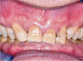  ??  ?? A case of moderate dental erosion where the teeth appear yellowish, due to the loss of enamel, making the dentine layer visible.