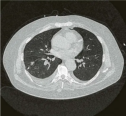  ?? Foto: Klinik für diagnostis­che und interventi­onelle Radiologie, Universitä­tsklinik Ulm ?? Schichtauf­nahme eines Brustkorbs: Die eingekreis­ten Bereiche sind Entzündung­sherde. Die Künstliche Intelligen­z, die in der Klinik für Radiologie an der Uniklinik Ulm ver‰ wendet wird, hat sie von ganz allein gefunden.