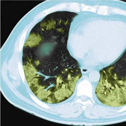  ?? © belga ?? CT-scan van de aangetaste longen van een 36-jarige coronapati­ënt.