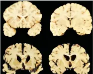  ?? AP PHOTO BY DR. ANN MCKEE ?? This photo shows sections from a normal brain, top, and from the brain of former University of Texas football player Greg Ploetz, bottom, in stage IV of chronic traumatic encephalop­athy.