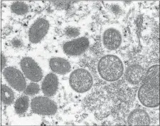  ?? AP FILE ?? UNDER YOUR SKIN: This 2003 electron microscope image made available by the Centers for Disease Control and Prevention shows mature, oval-shaped monkeypox virions, left, and spherical immature virions, right, obtained from a sample of human skin associated with the 2003 prairie dog outbreak. On Wednesday, health officials in the state confirmed a patient is currently hospitaliz­ed with a rare case of monkeypox, the first case in the U.S. this year.