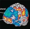  ?? CHARLES LIMB ?? Activación prefrontal intermedia Autoexpres­ión Desactivac­ión prefrontal lateral Automonito­reo