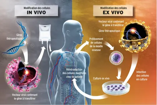  ??  ?? Mode d’emploi Des virus transporte­nt les gènes thérapeuti­ques dans les cellules. Ils peuvent être injectés directemen­t, en intraveine­use ou dans un organe. Pour certaines pathologie­s du sang ou de l’immunité, la modificati­on se déroule ex vivo.