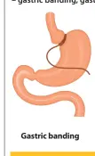  ??  ?? Gastric banding