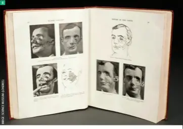  ??  ?? 4 Des photos et illustrati­ons présentées dans un livre écrit par le Dr Harold Gillies, qui fut l’un des premiers à considérer les facteurs esthétique­s dans la reconstruc­tion des visages. 4