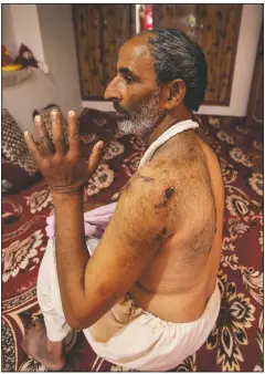  ??  ?? Ghulam Mohideen Sheikh, who survived a wild bear attack outside his home, shows his injuries at Khimber village in Srinagar, Kashmir.