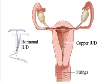  ??  ?? A intrauteri­ne device ( IUD)