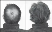  ??  ?? Breakthrou­gh research proves this discovery helps fill-in bald spots, re-nournishes thinning hair, and leads to noticeable growth in as little as 30 days.