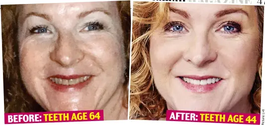  ??  ?? BEFORE: TEETH AGE 64AFTER: TEETH AGE 44 Transforma­tion: Louise, 54, pictured before and after her treatment, is all smiles today