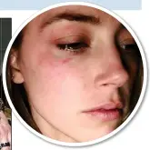  ?? ?? Depp with Amber Heard three months before their alleged altercatio­n. Above: Bruises she claims he inflicted on her VOLATILE RELATIONSH­IP: