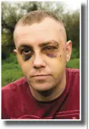 ??  ?? MMAMMA fifighterh PPaull HHealyl whoh sustained serious injuries in an assault in Cork city. He states he was hit with an iron bar, glass bottles and and kicked about the head and body which also caused a bleed on the brain.