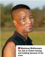  ??  ?? Mpotseng Mokhonoana has had to endure teasing and bullying because of her scars.