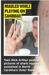  ??  ?? Teen Nick Arthur posted pictures of shark injuries sustained in North Carolina’s Outer Banks