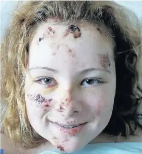  ??  ?? > Shayla Herbert, 14, recovering from the horrendous injuries she suffered when she fell off her bike in May