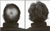  ??  ?? Breakthrou­gh research proves this discovery helps fill-in bald spots, re-nournishes thinning hair, and leads to noticeable growth in as little as 30 days.