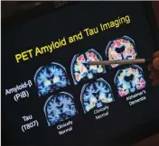  ?? ASSOCIATED PRESS ?? IN THIS MAY 19, 2015, file photo, R. Scott Turner, Professor of Neurology and Director of the Memory Disorder Center at Georgetown University Hospital, points to PET scan results that are part of a study on Alzheimer’s disease at Georgetown University Hospital in Washington.