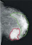  ??  ?? In this mammogram image, the red area is cancer and green is normal dense breast tissue.