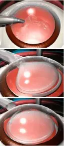  ??  ?? The replacemen­t process (from top): making an incision, inserting the new lens, unfolding it, the new lens in situ.