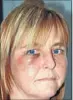  ??  ?? BATTERED: Tokoroa mother Maxine Lozell sustained facial and torso injuries after being attacked during an attempted home robbery last week.