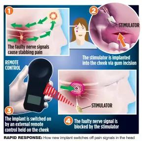 Tap On The Cheek Turns Off Red Hot Poker Headaches Pressreader