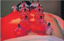  ?? [CHRIS LANDSBERGE­R/THE OKLAHOMAN] ?? As Dr. Amit Gumman of Harmony Healing Center explained, cupping therapy is an ancient process. Its roots trace back thousands of years to Buddhist monks in India, who then went out into the world. As they did, they spread the practice of cupping far and wide.