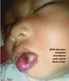 ??  ?? AISYA Qhumaira
mengalami ketumbuhan pada saluran darah di bibir.