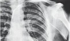  ?? Foto: Wikimedia ?? Die Röntgenauf­nahme von Forßmanns Selbstvers­uch