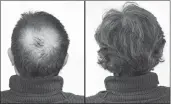 ??  ?? Breakthrou­gh research proves this discovery helps fill-in bald spots, re-nournishes thinning hair, and leads to noticeable growth in as little as 30 days.
