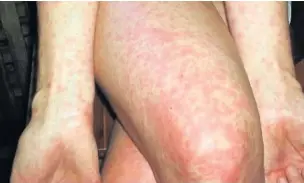  ??  ?? ●●Examples of scarlet fever