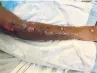  ??  ?? Azeriah Jeremiah, 8, suffered burns after hot tar fell on him at his school.