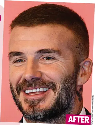 ?? Pictures:SPLASHNEWS.COM/AFPGETTY ?? On his head: Becks’s new look and, left, picture that sparked transplant rumours. Inset, in his football heyday AFTER