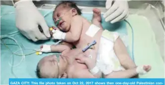  ??  ?? GAZA CITY: This file photo taken on Oct 22, 2017 shows then one-day-old Palestinia­n conjoined twins in an incubator at the nursery at the Al-Shifa Hospital. — AFP