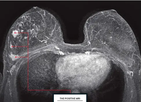  ?? ?? THE POSITIVE MRI An MRI of the same patient three months after her mammogram. The MRI depicts as many as three cancers in her right breast plus some precancero­us lesions, all of which were invisible on her mammogram.